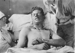 A victim of the mustard gas
